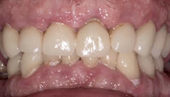 Before and after comparison of full arch zirconia prostheses.
