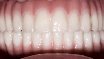 Before and after images of full arch zirconia prostheses.