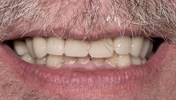 Before and after images of full arch zirconia prostheses.