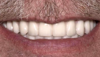 Before and after images of full arch zirconia dental prostheses.