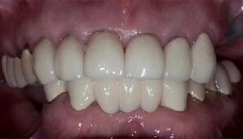 Before and after images of upper and lower dental prostheses.