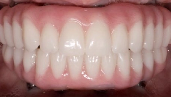 Before and after images of full arch prostheses replacement.