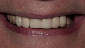 Before and after images of upper and lower dental prostheses.