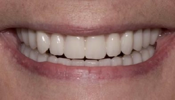 Before and after images of full arch acrylic/titanium prostheses.