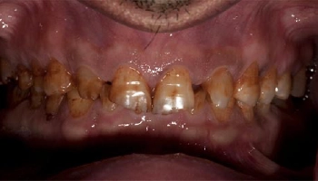 Before and after images of a full mouth reconstruction.