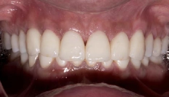 Before and after images of dental crowns and crown lengthening.