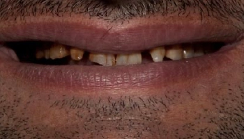 Before and after images of dental crown procedures.