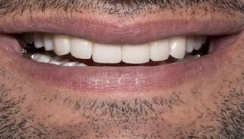 Before and after images of a full mouth reconstruction procedure.