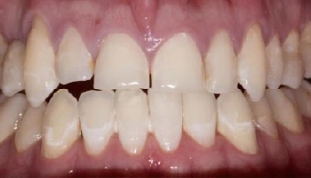 Before and after photos of porcelain layered zirconia crowns on teeth.
