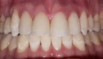 Transformed smile showcasing porcelain layered zirconia crowns.