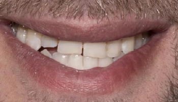 Before and after image of polished zirconia crowns on teeth.