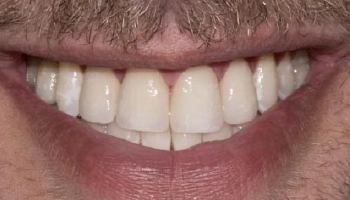 Before and after comparison of porcelain layered zirconia crowns.