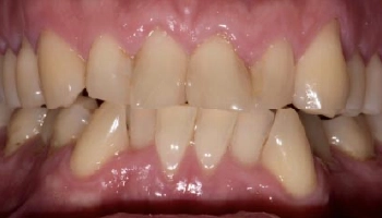 Before and after images showcasing improved smile aesthetics with dental treatments.
