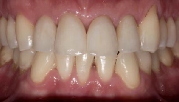 Transformed smile showcasing orthodontics, whitening, and zirconia crowns.