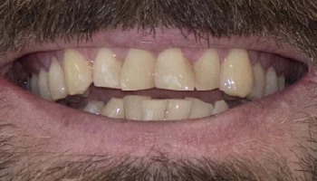 After photo showing bright, aligned teeth with porcelain zirconia crowns.