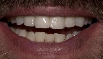 Transformed smile showcasing orthodontics and porcelain crowns.