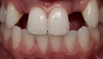 Before and after images of lateral incisor implants with crowns.
