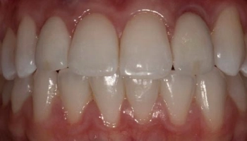 Before and after images of lateral incisor implants with crowns.