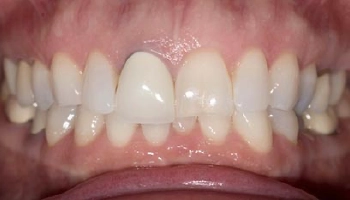 Before and after of central incisor zirconia crowns.