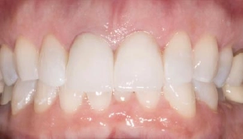 Comparison of before and after central incisor crowns.