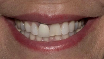 Before and after of central incisor zirconia crowns.