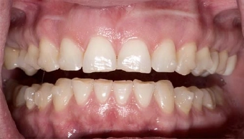 Before and after comparison of central incisor zirconia crowns.