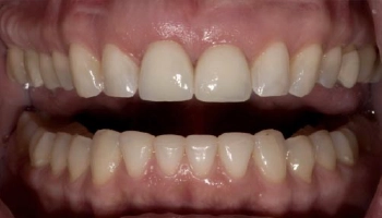 Before and after comparison of central incisor zirconia crowns.