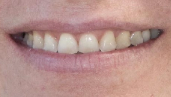 Transformation of central incisors with porcelain layered zirconia crowns.