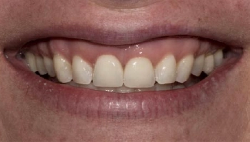 Before and after images of central incisor crowns.