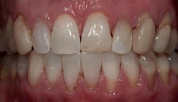 Before and after images of ceramic crowns and veneers on teeth.