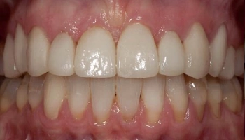 Before and after image of dental crowns and veneers.