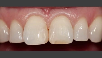 Before and after images of ceramic crown dental treatments.
