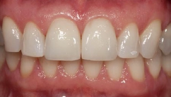 Transformed smile showcasing ceramic crowns in before/after comparison.