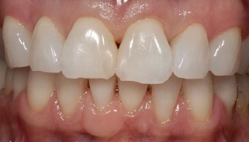 Before and after images of a patient’s smile with ceramic crowns.