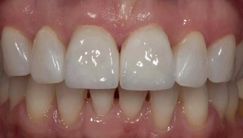 Before and after comparison of ceramic crowns on teeth.