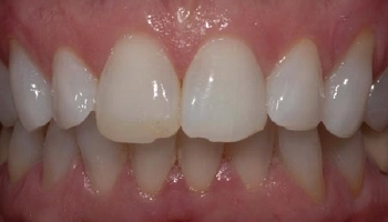 Before and after comparison of ceramic crowns on teeth.