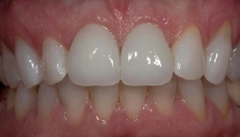 Before and after images of ceramic crowns on teeth.