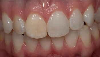 Before and after results of porcelain veneer treatment on a smile.