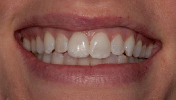 Before and after porcelain veneer treatment on a smile.
