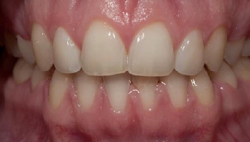 Before and after dental whitening results, showcasing improved teeth brightness.