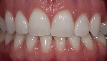 Before and after comparison of teeth whitening results.