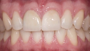 Before and after images of central incisor veneers.
