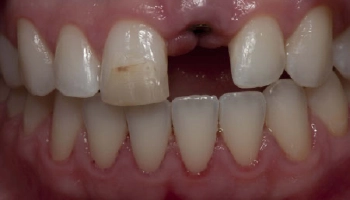 Before and after dental restoration with implant, crown, and veneer.