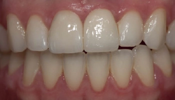 After dental restoration featuring an implant, crown, and veneer.