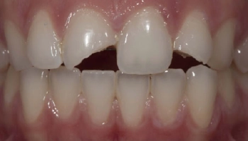 Before trauma image showing dental crowns and patient condition.