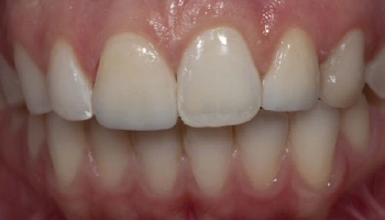 A dental crown showing improvement after trauma treatment.