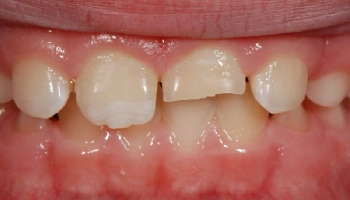 Before and after images of tooth fragment reattachment with composite bonding.
