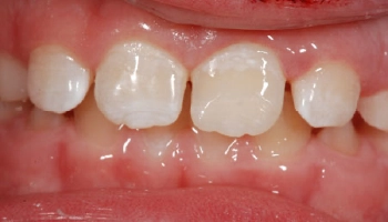 Dental restoration showing composite bonding after trauma repair.