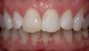Before and after images showing transformation with ceramic crowns.