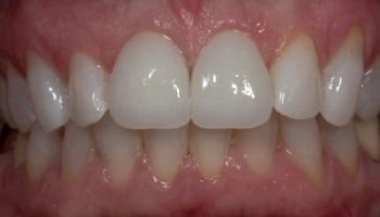 After image showing improved smile with ceramic crowns.